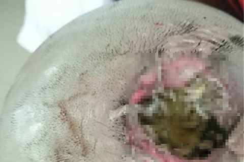 Soffre di mal di testa da 40 anni I medici le trovano un ago piantato nel cranio