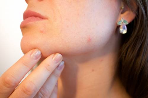 Acne: come nascondere cicatrici, brufoli e pori dilatati