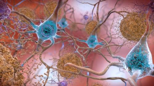 Alzheimer, il litio a piccole dosi potrebbe fermarlo