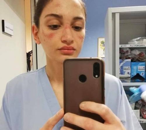 L'infermiera con il volto segnato dalla mascherina: "State in casa"