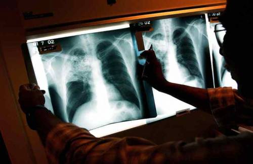 Segni di polmonite interstiziale: così le Rx scovano gli asintomatici