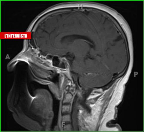 Covid-19 e i danni il cervello: così viene colpito indirettamente