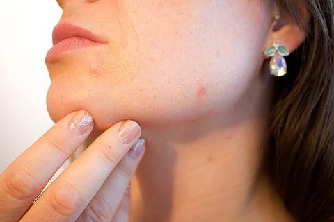 Acne da mascherina o "maskne": perché si manifesta?