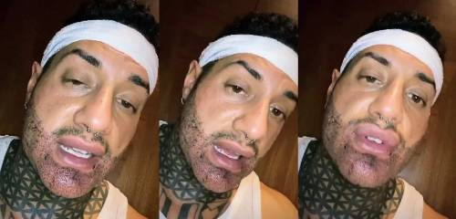 Chiofalo fa il trapianto di barba: ma il post-operazione diventa uno show