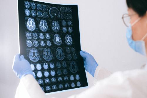 Ictus, rischio più elevato nei pazienti con Covid