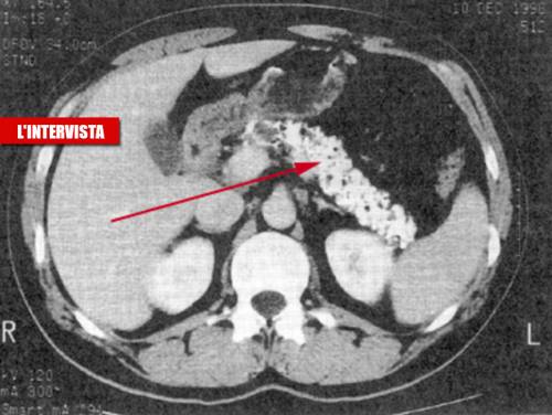 Il Covid "gonfia" il pancreas: "Ecco come scatta l