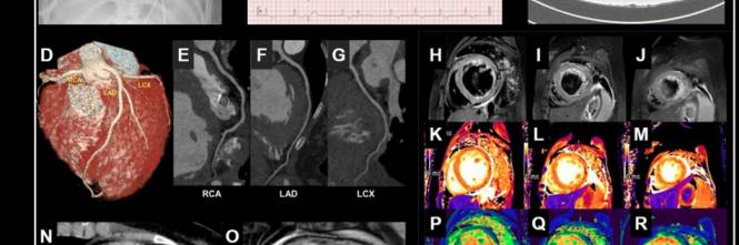 miocardite e infarto miocardite e infarto