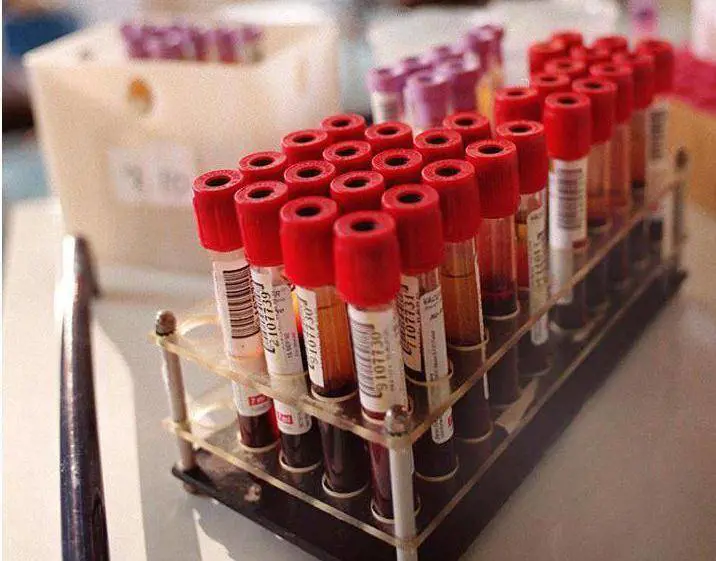 Se basta l'esame del sangue a stanare il cancro ai polmoni