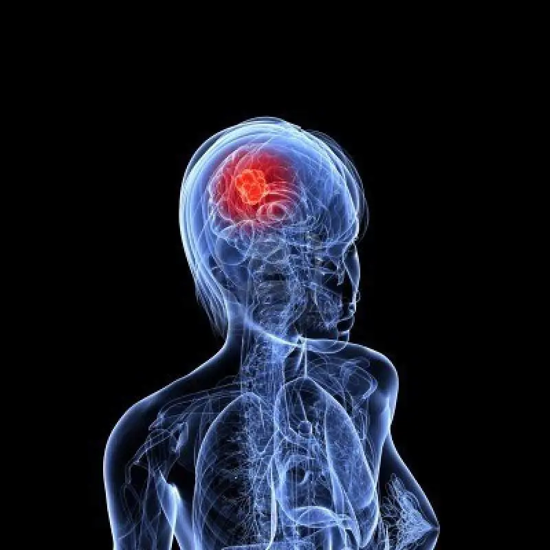 Scoperta lʼorigine dellʼAlzheimer: è nellʼarea del cervello che regola umore