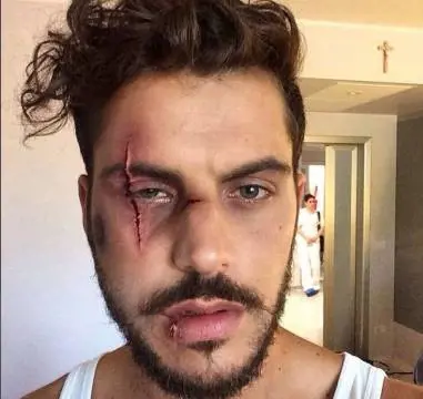 Isola dei Famosi, Andrea Montovoli e la foto in ospedale su Facebook