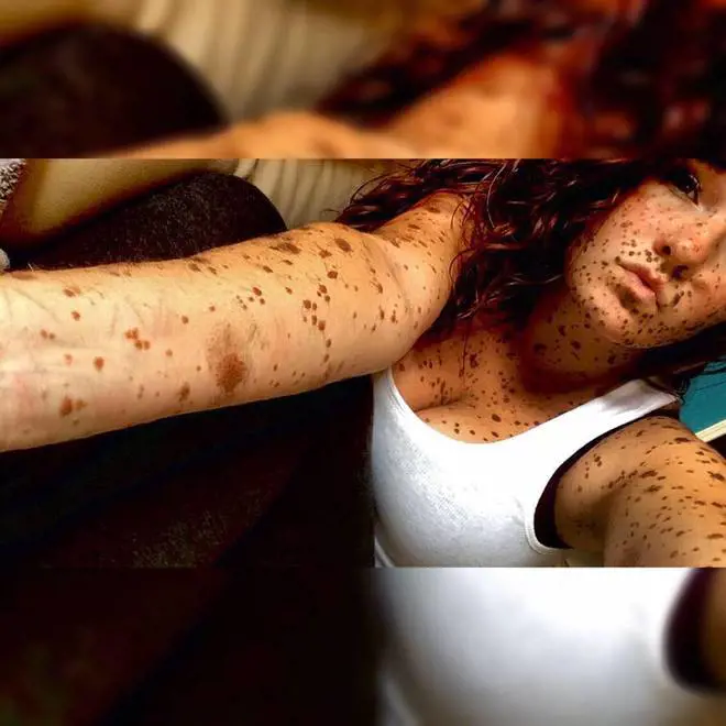 Ha il 70% del corpo coperto dai nei: "Così ho reagito al bullismo"