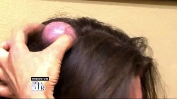 Schiaccia ciste dopo 20 anni Il video è choc