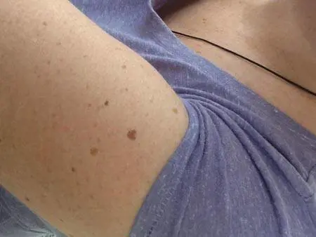 Scoperta una relazione tra i nei presenti sul braccio e il rischio di melanoma