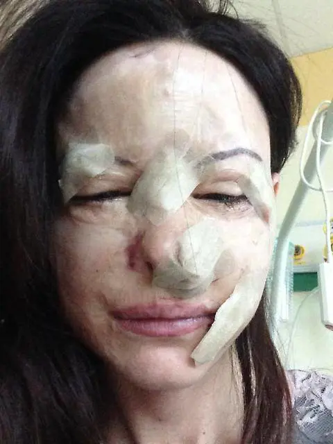 Lucia Annibali, su twitter la foto sfregiata dall'acido
