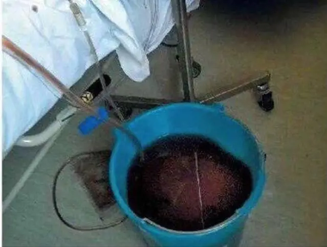 Sangue raccolto nei secchi, sotterranei lugubri e rifiuti radioattivi: la sanità del Lazio