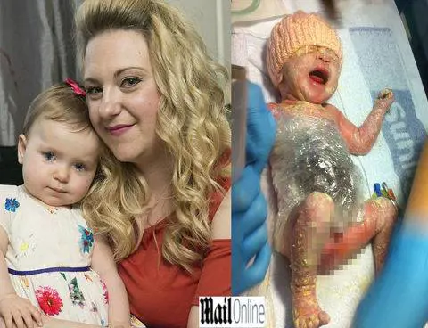 Nasce con organi fuori dall'addome. Bimba salvata da pellicola trasparente