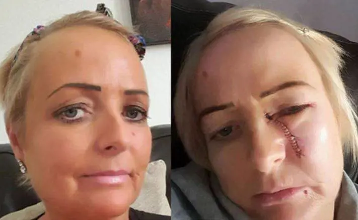 Puntino sul viso dopo lettino solare. Scopre di aver un cancro alla pelle