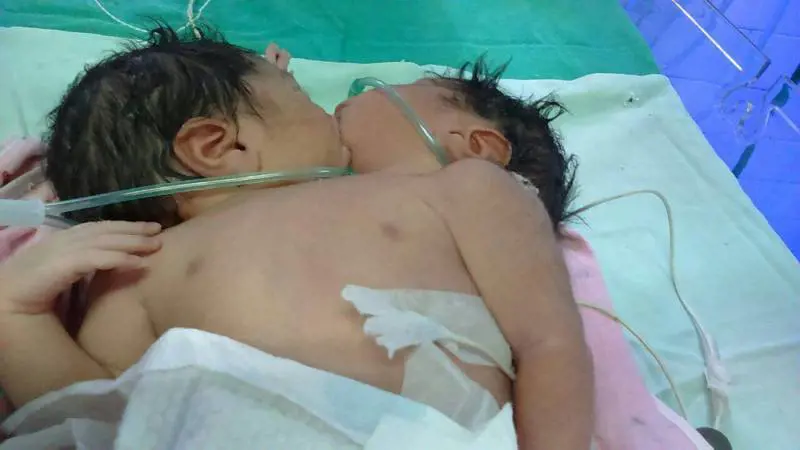 Quei gemelli nati con un corpo soltanto