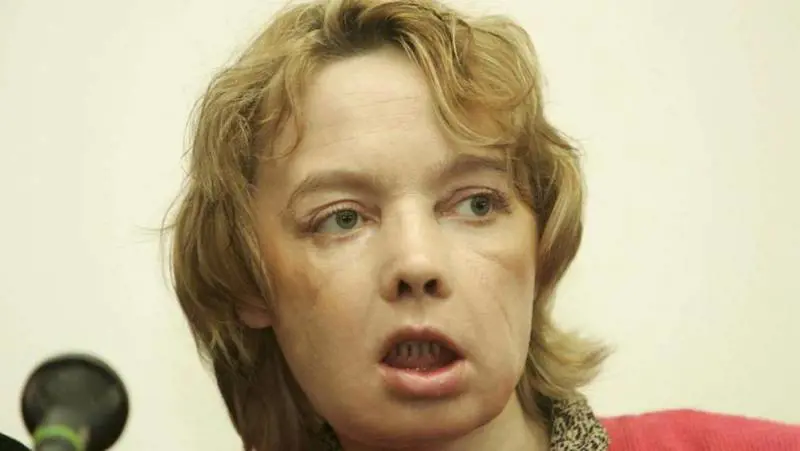 È morta Isabelle, prima donna sottoposta al trapianto del viso
