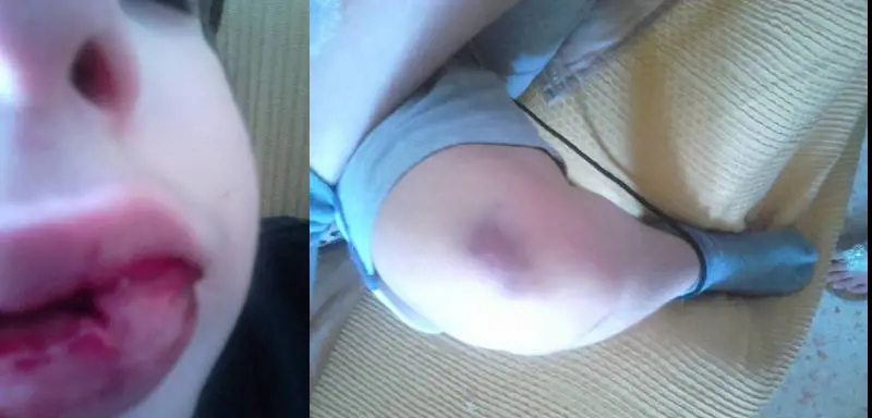 La madre di un disabile: "Mio figlio picchiato a scuola dai bulli"