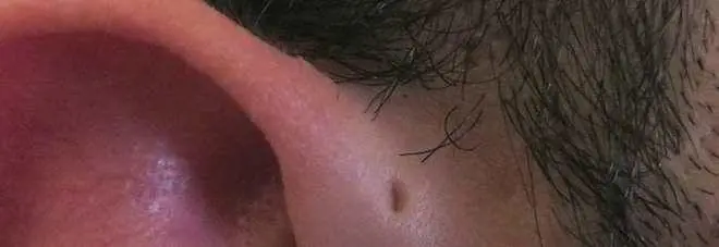 Buchi o rigonfiamenti all'orecchio? Ecco cosa sono