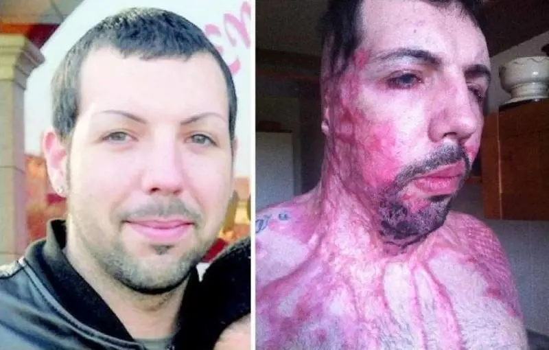 Uomo sfregiato con l'acido: "Se la vittima è un maschio è meno considerato"