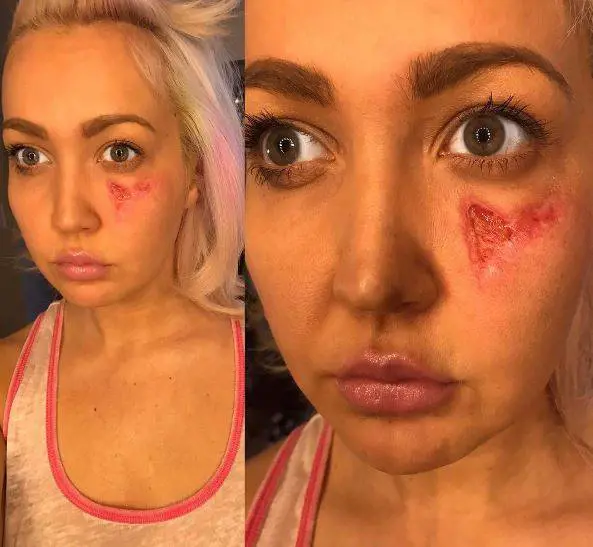 Meghan Linsey morsa da un ragno violino: "Sono contenta di essere viva"