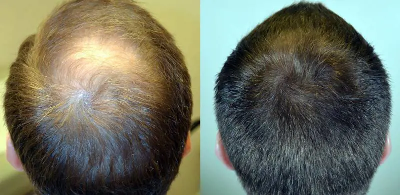 Caduta Capelli e Calvizie, le nostre cellule possono curarla senza chirurgia