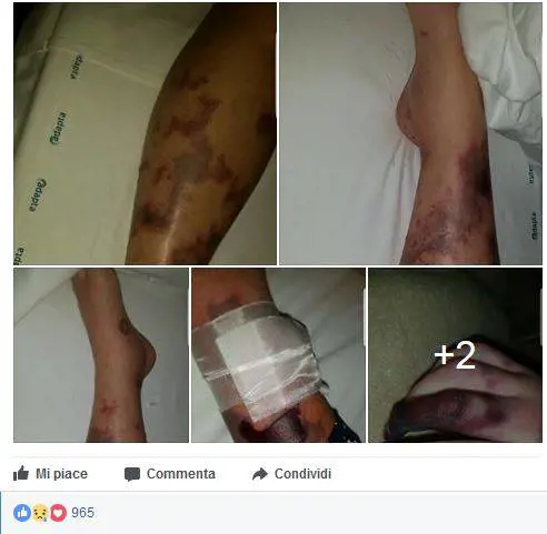 "Ridotta così dalla meningite. L'ho presa perché non vaccinata"