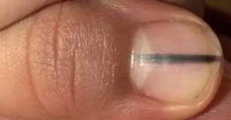 Ecco che cosa succede alle mani di chi si mangia spesso le unghie