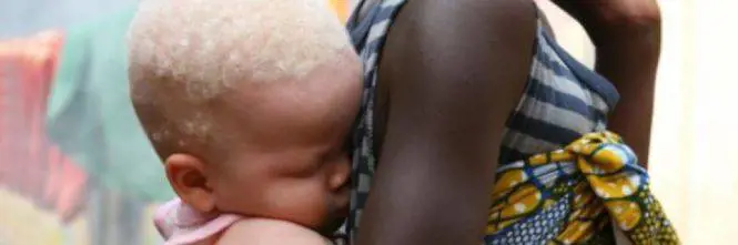 Mozambico, bambino albino ucciso e mutilato: rubato il cervello
