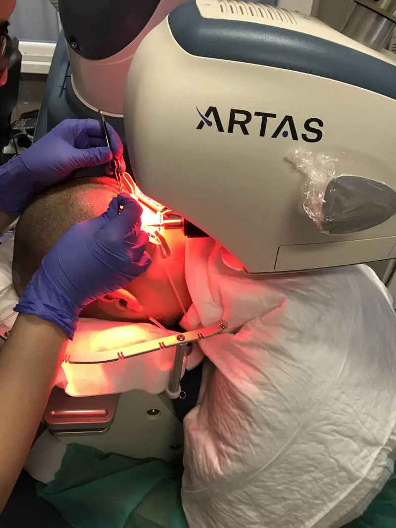 Novità per il trapianto di capelli: il sistema robotico arriva in Italia