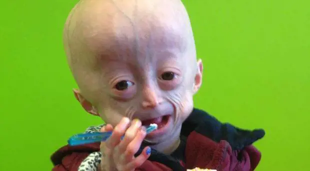 È morta Lucy Parke, la bimba di otto anni con il corpo di una centenaria