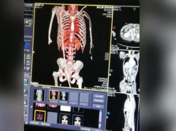 Cade da un palazzo e finisce trapassato da barra d’acciaio: è salvo