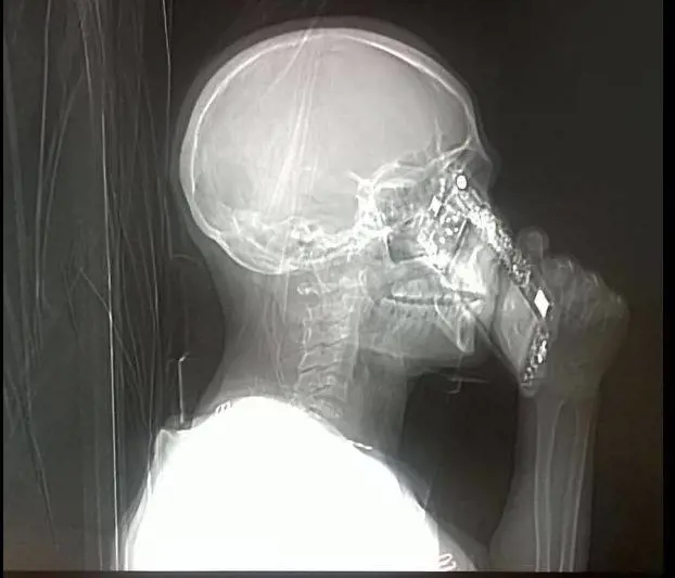 Risponde al cellulare durante la Tac, medici allibiti a Napoli