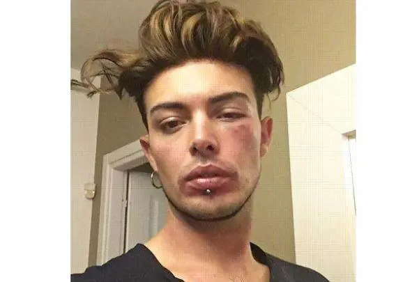 Stash e la foto col volto pestato: "Stavo difendendo una ragazza"