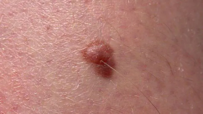 Melanoma, sempre più rischi tra i giovani: il 40% non usa mai la crema solare