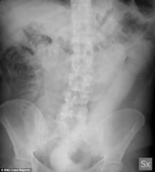 "Aiuto, ho male alla pancia": ma nel retto ha dildo di 60cm. I medici del Niguarda lo salvano