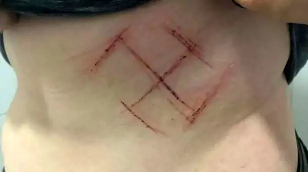 Brasile, incidono una svastica sulla pancia di una ragazza