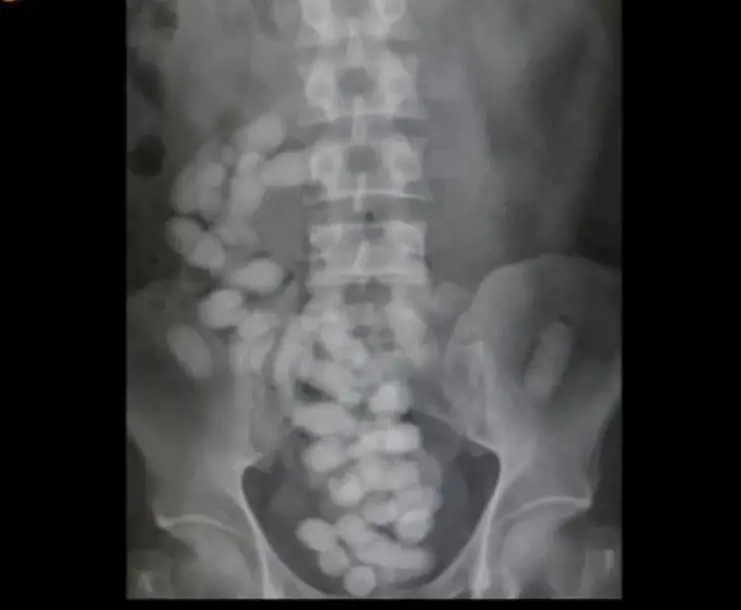 Sassari, arrestato corriere droga: 34 ovuli di eroina nell’intestino