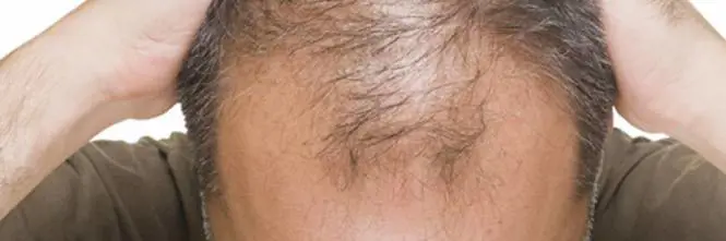 Medici finti trapiantavano capelli in ospedale, denunciati 