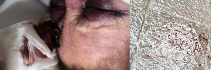 Napoli, violenza inumana dei ladri: massacrata e lasciata in un lago di sangue