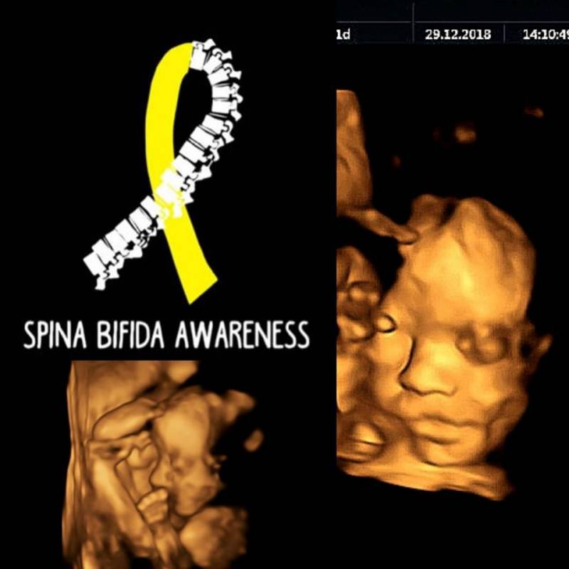 feto spina bifida