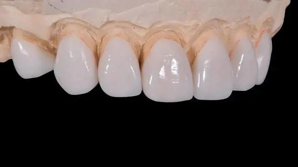 Dimentica la dentiera nel vassoio del pranzo e dice addio ai denti