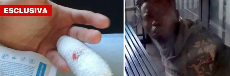 Torino, nigeriano morde poliziotto e gli strappa la falange