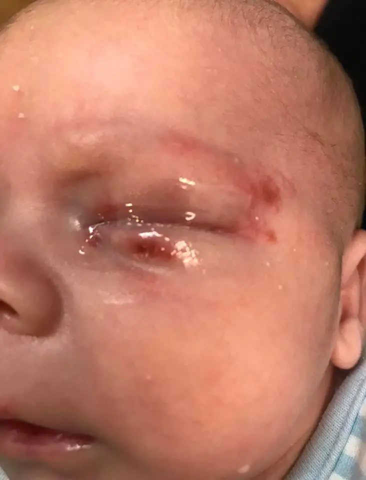 Baciato da un parente con l'Herpes: neonato rischia di morire