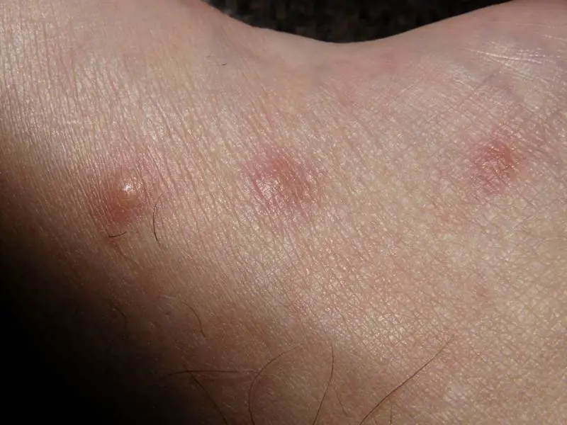 Orticaria, in Italia ne soffrono 5 milioni