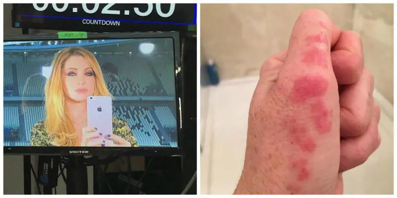 Paola Ferrari punta da una medusa: "Dopo cinque giorni non migliora"