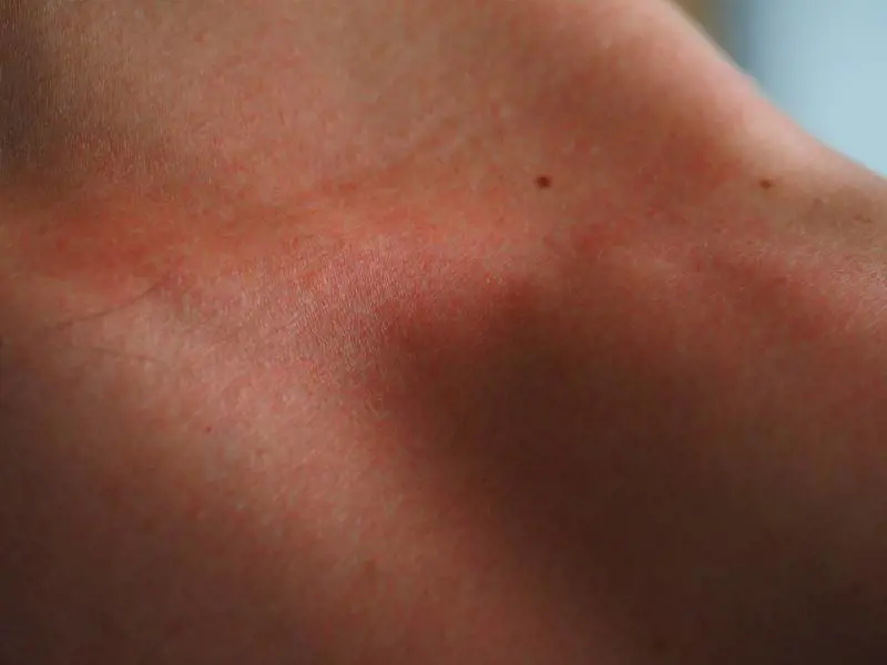 Melanoma cutaneo: perché in estate aumentano i rischi