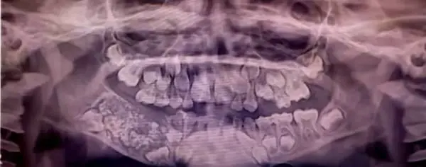 L'estrazione da record: tolti 526 denti a un bambino di 7 anni